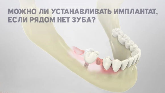 Можно ли поставить зубной имплант, если рядом нет зуба?